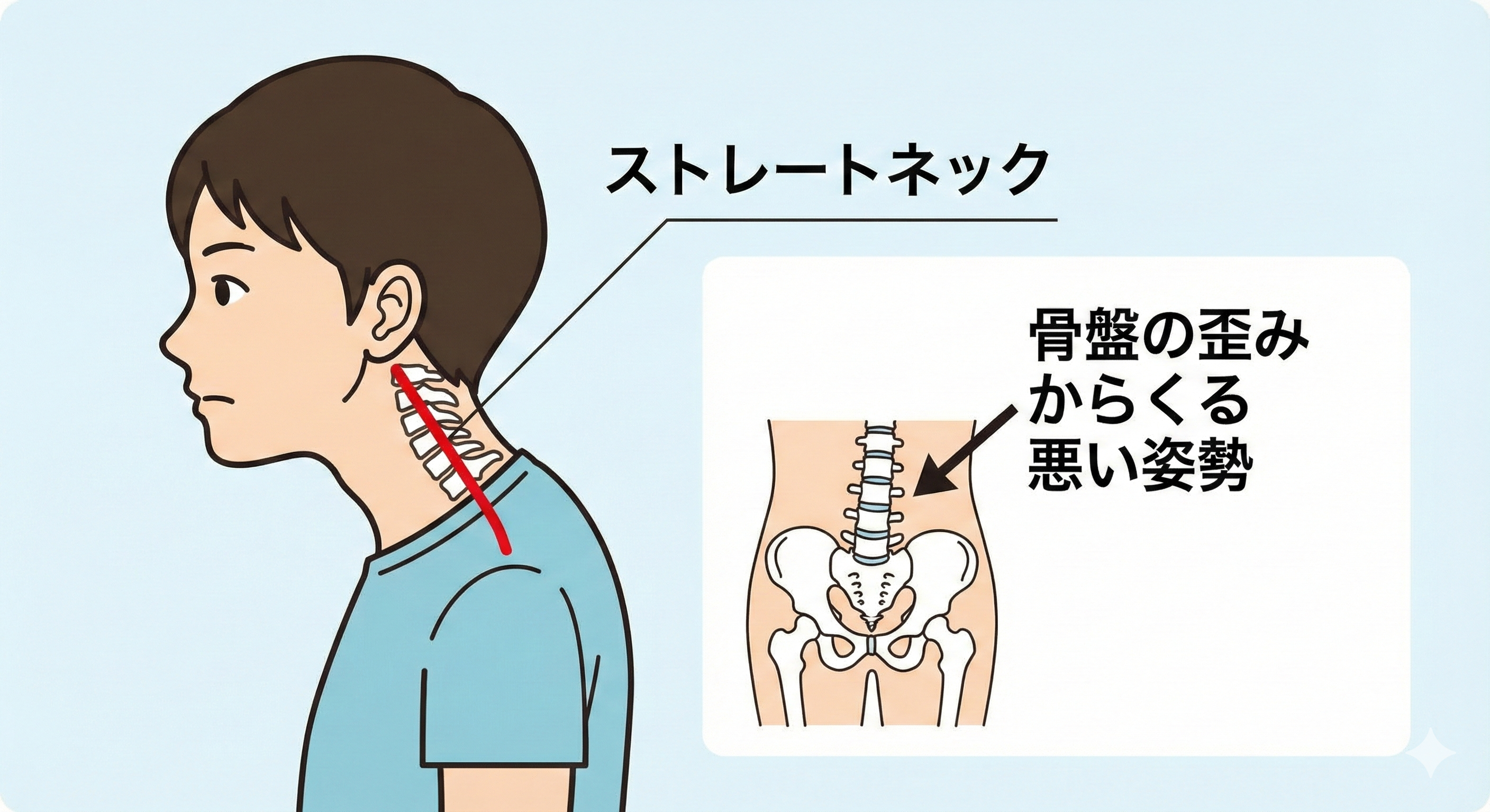 ストレートネックと姿勢の悪さのイメージ