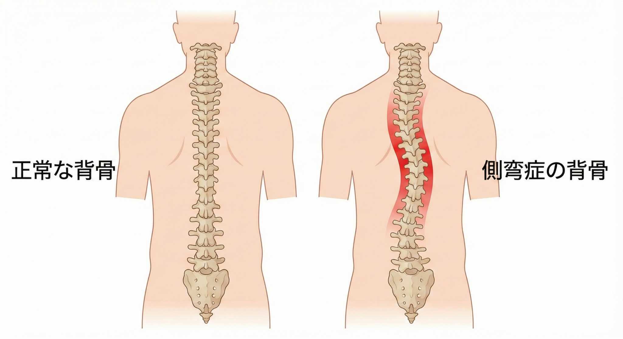 側弯症の背骨の図解