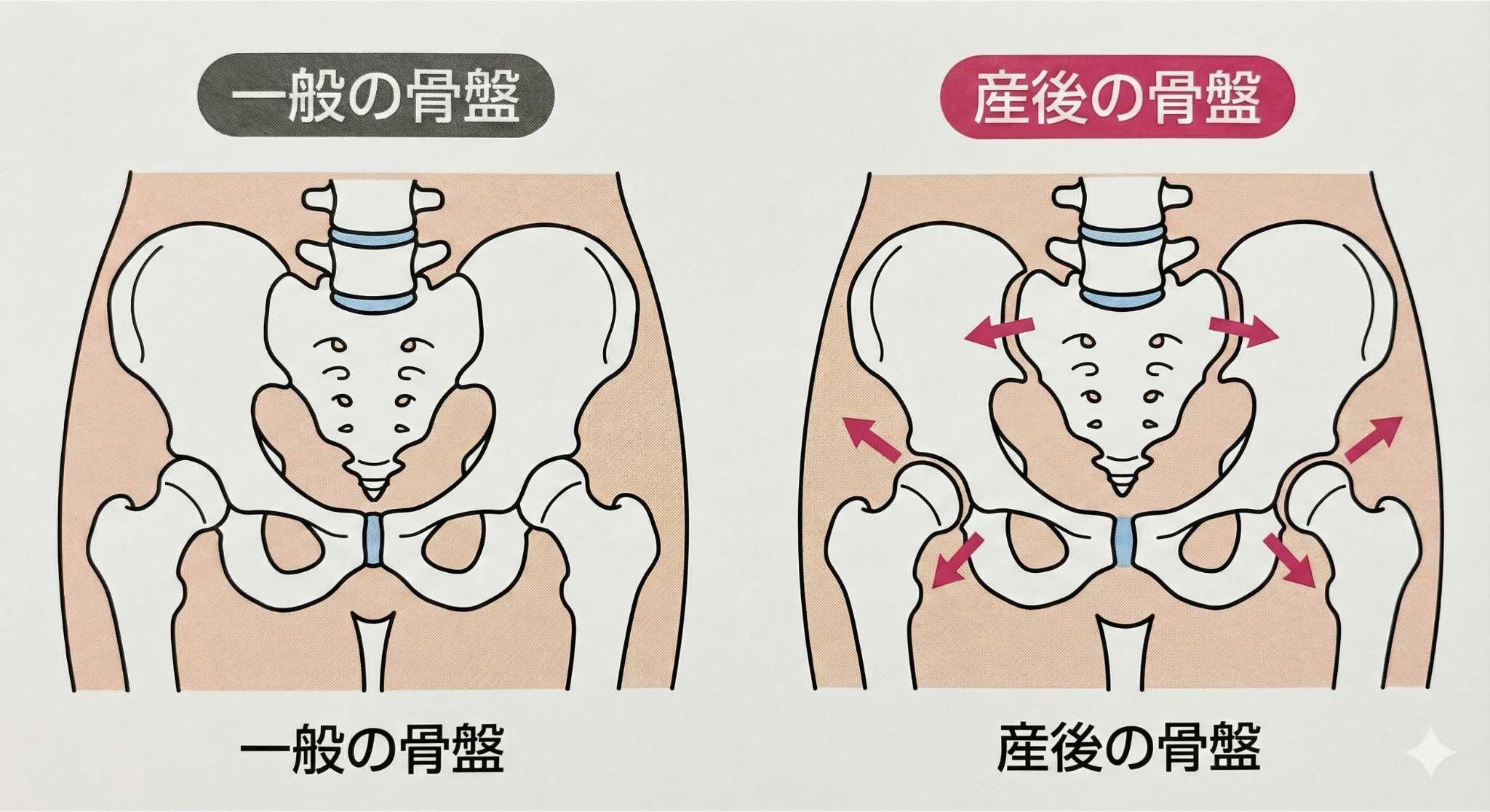 産後と一般の骨盤の違いイメージ