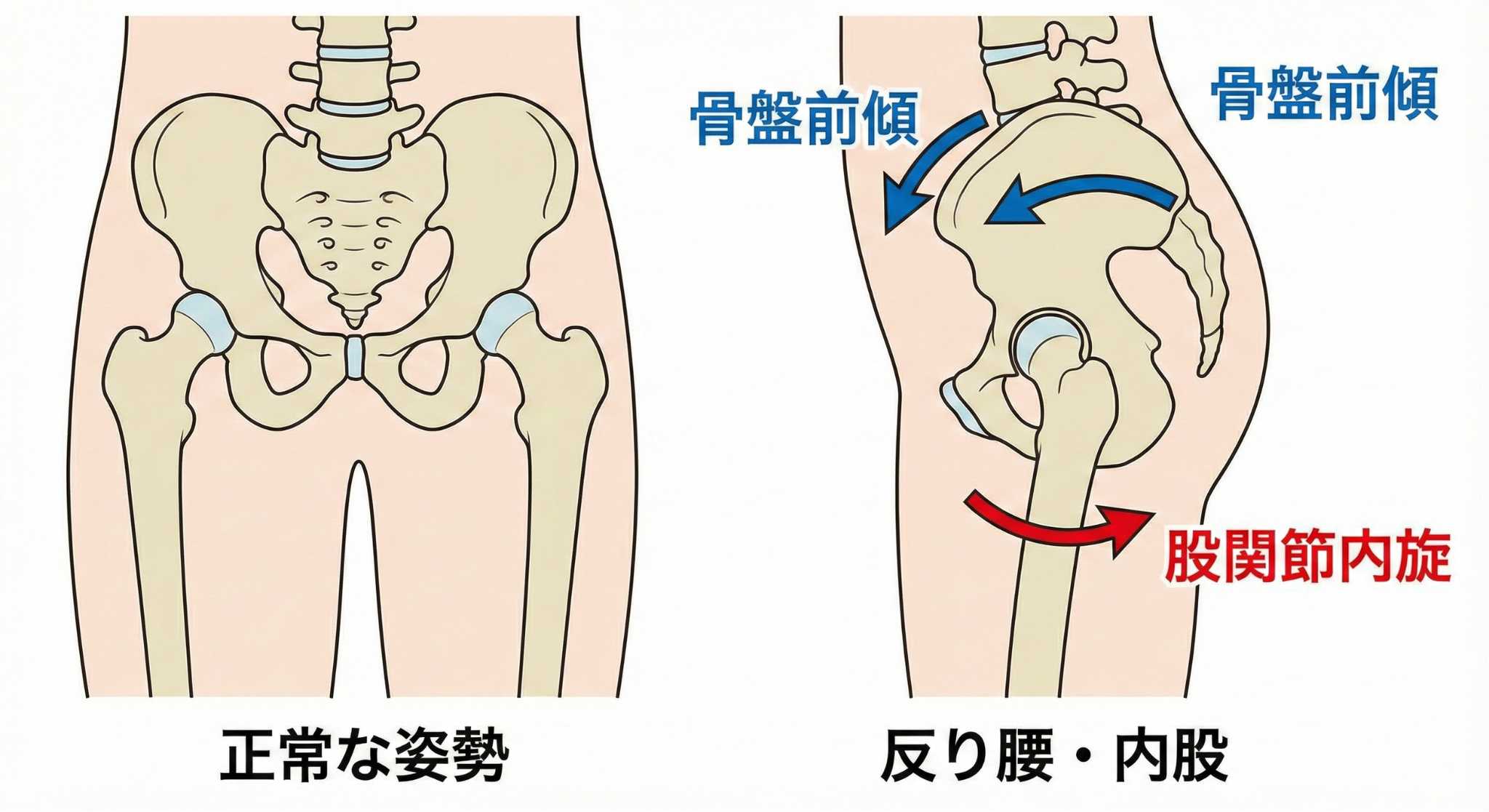 姿勢分析で骨盤の歪みを確認するイメージ