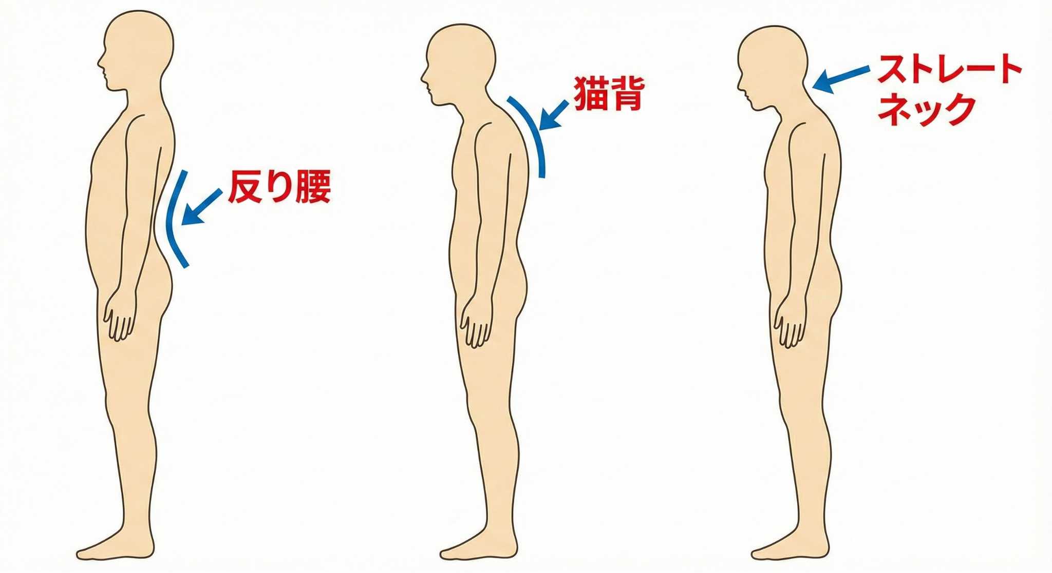 動画を見て、ショックを受けた猫背 ― 40代男性の改善事例 ―