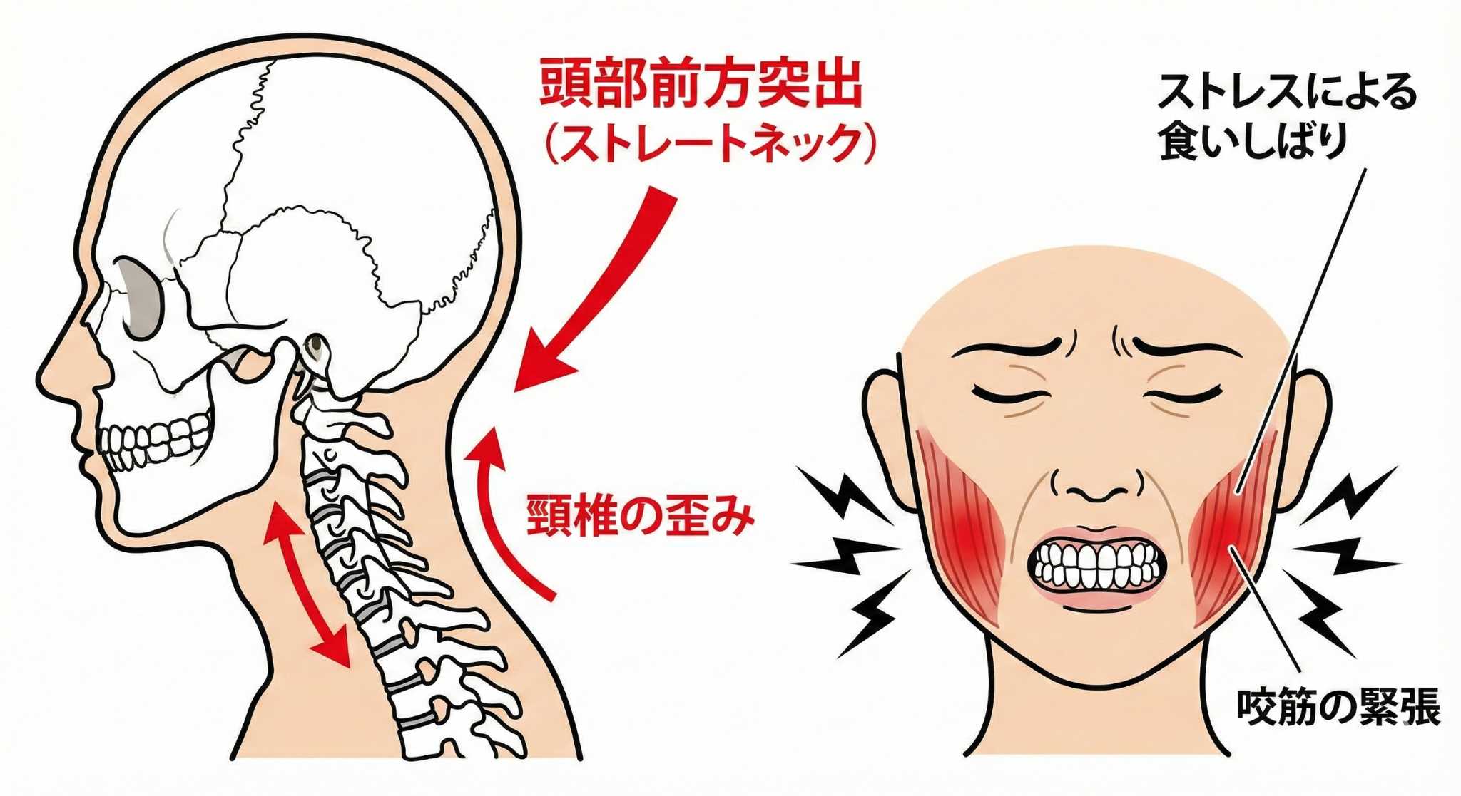 首の歪みと食いしばりのイメージ
